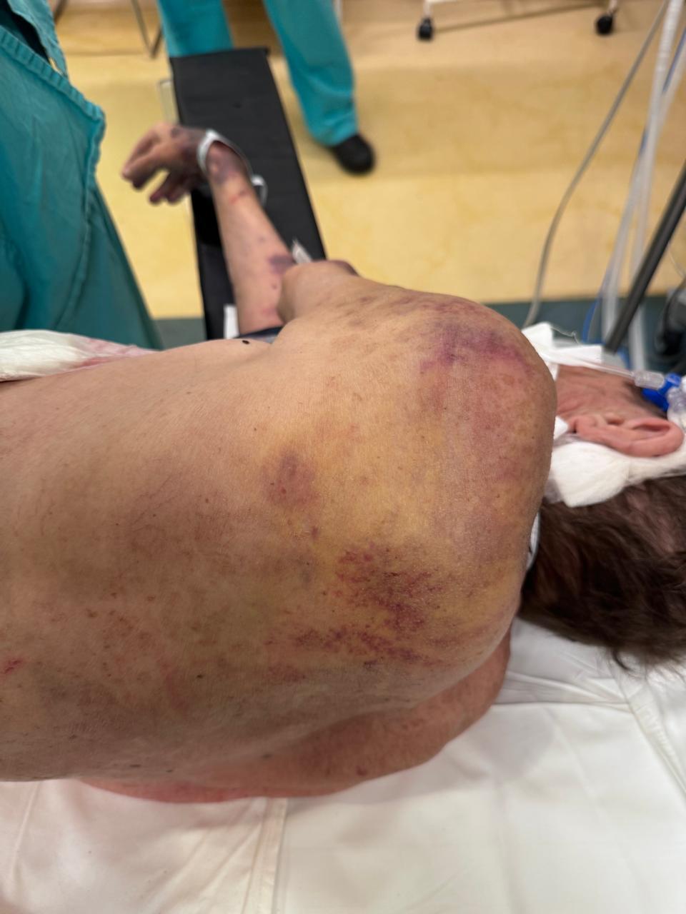 Entradera en Funes: así quedó el jubilado de 74 años por los golpes de los detenidos que podrían quedar libres